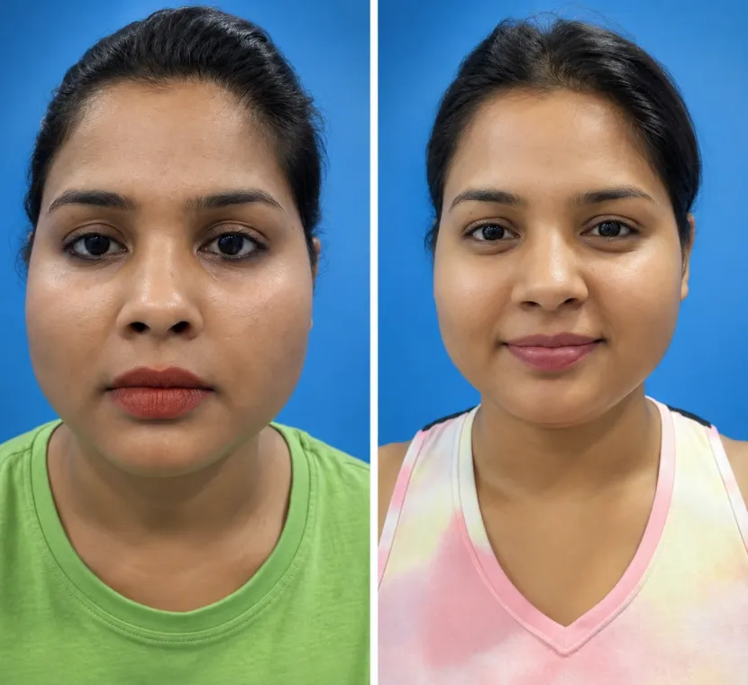 Facial Enhancement – before and after