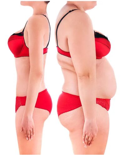 Tummy Tuck