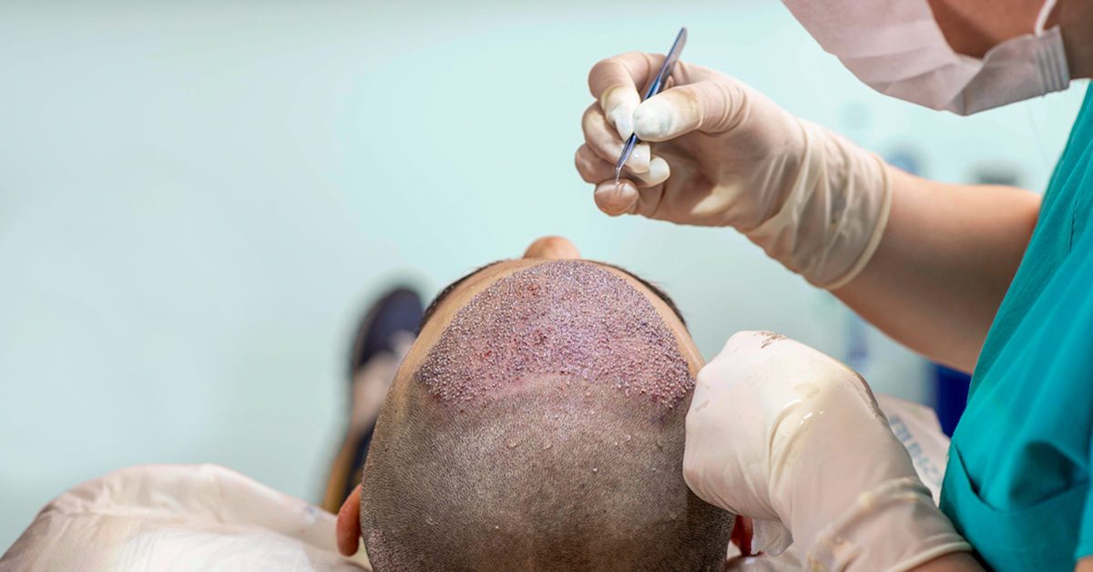 FUE Hair transplant - Dr. Vivek Gupta's Clinic, Lucknow