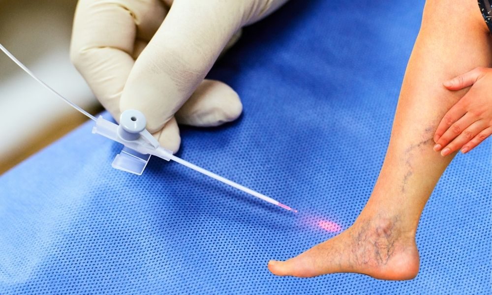 Varicose vein - Dr. Vivek Gupta's Clinic, Lucknow