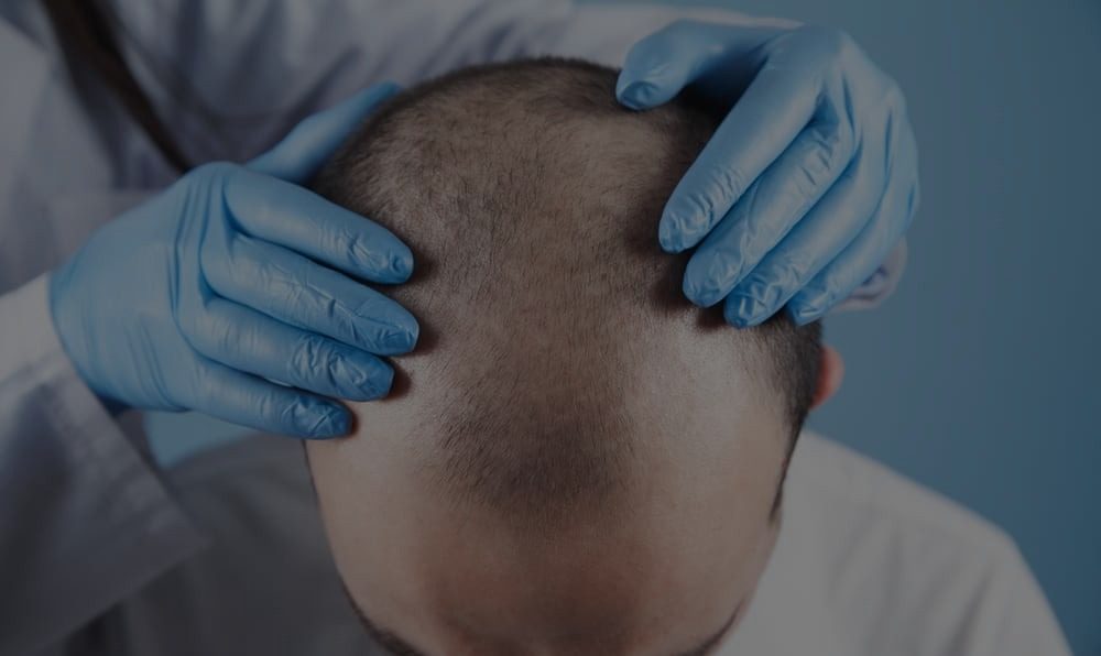 FUE Hair Transplant - Dr. Vivek Gupta's Clinic, Lucknow