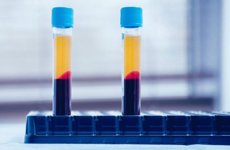 Platelet-rich Plasma treatment at Dr. Vivek Gupta's Clinic, Lucknow